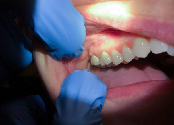 Best Emergency Treatment for Dental Infections or Abscesses in Fairport Harbor, OH